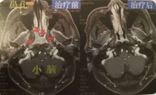 tomo刀实例,tomo刀效果