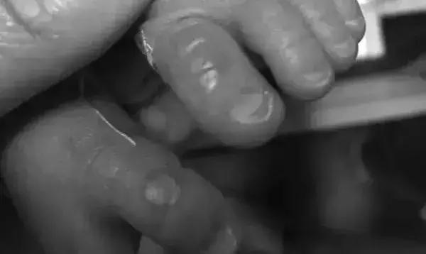 黄疸治疗不及时，宝宝居然会脑瘫？