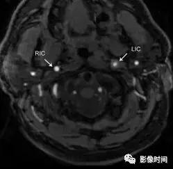 双侧颈动脉鞘间隙多发小淋巴结影,双侧颈动脉间隙多软组织密度结节