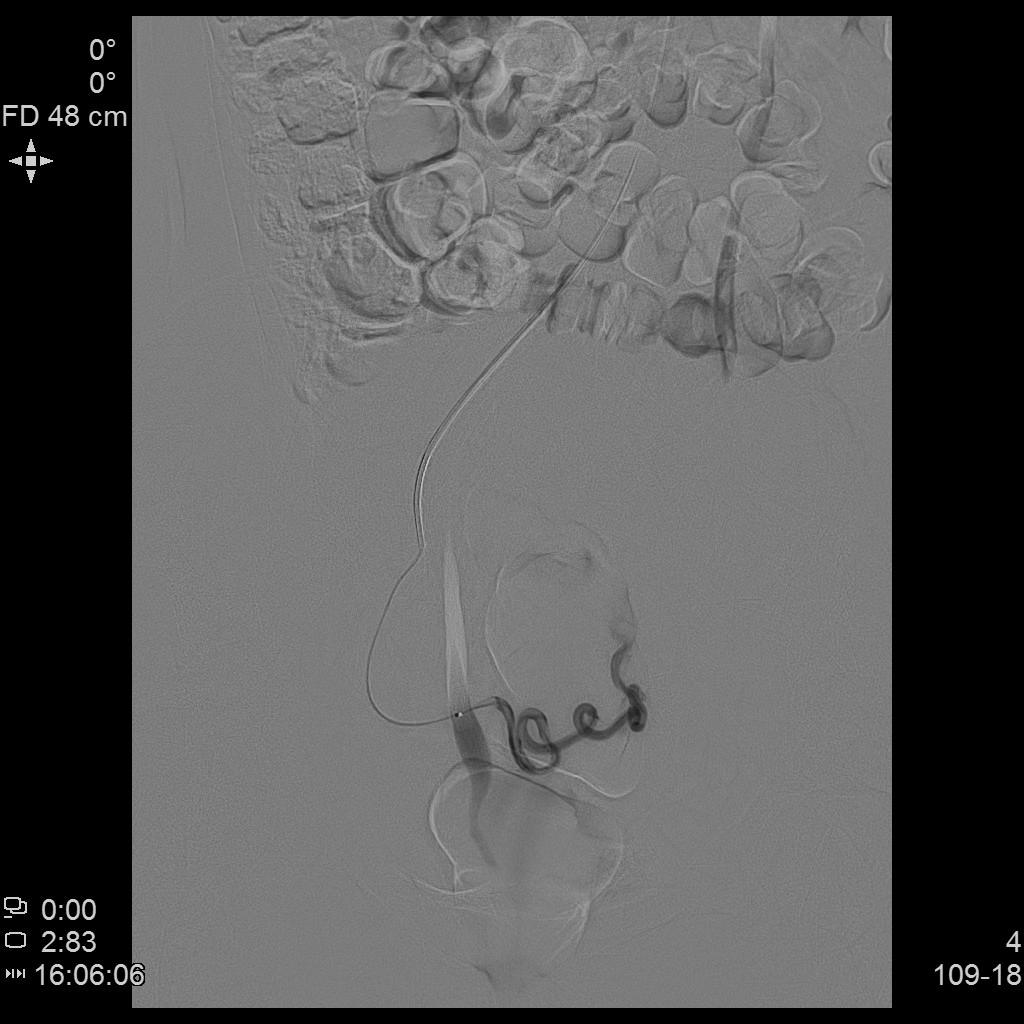 子宫肌瘤介入栓塞术排出黄水,子宫肌瘤介入消融治疗