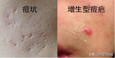 掏了室友脸上一颗大黑头，留了一个大洞，该怎么办？