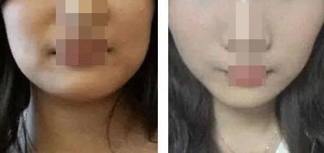 线雕除皱什么意思,线雕除皱可以同时做吗