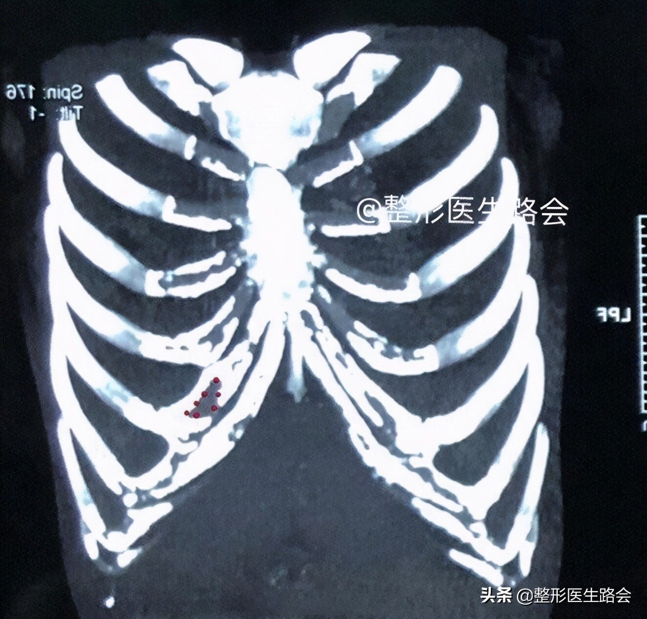 假体材料都有哪几种,假体材料都有什么