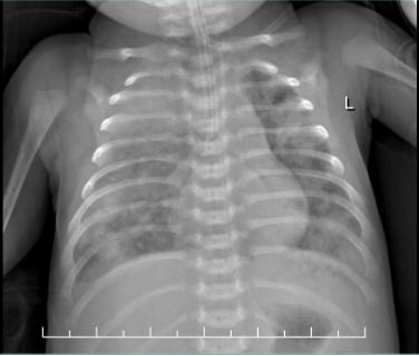 医护奋战27小时救回羊水栓塞产妇,广西驰援武汉护士抢救26天