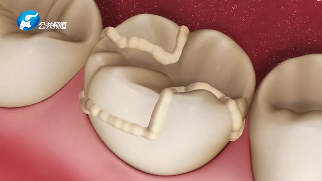 关注口腔爱在植得|补牙≠填洞，第一次补牙你应该知道的事