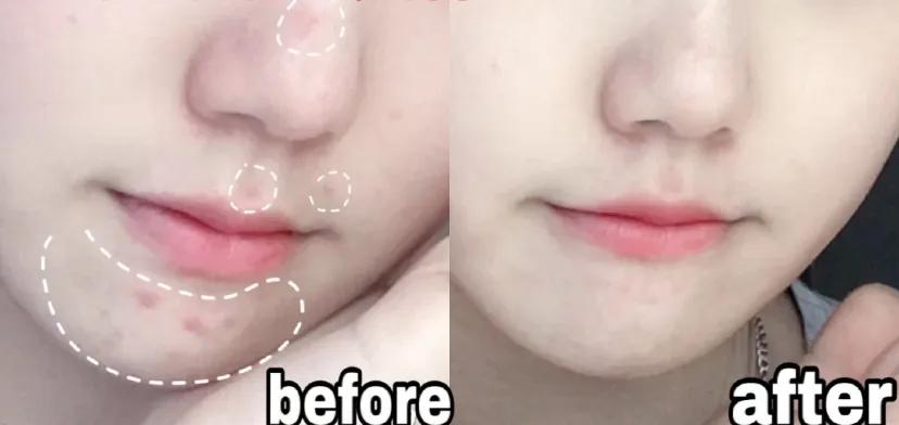 李佳琦推荐的痘痘贴,李佳琦推荐痘痘贴面膜