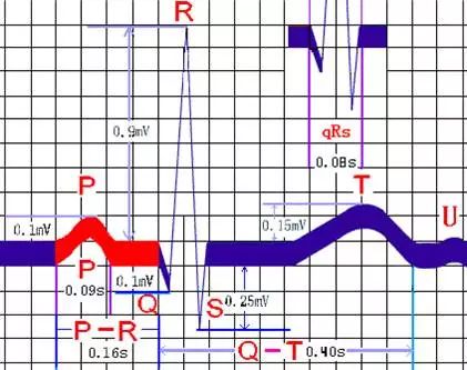 心律失常55分钟讲解,心律失常心电图讲解视频教程全集