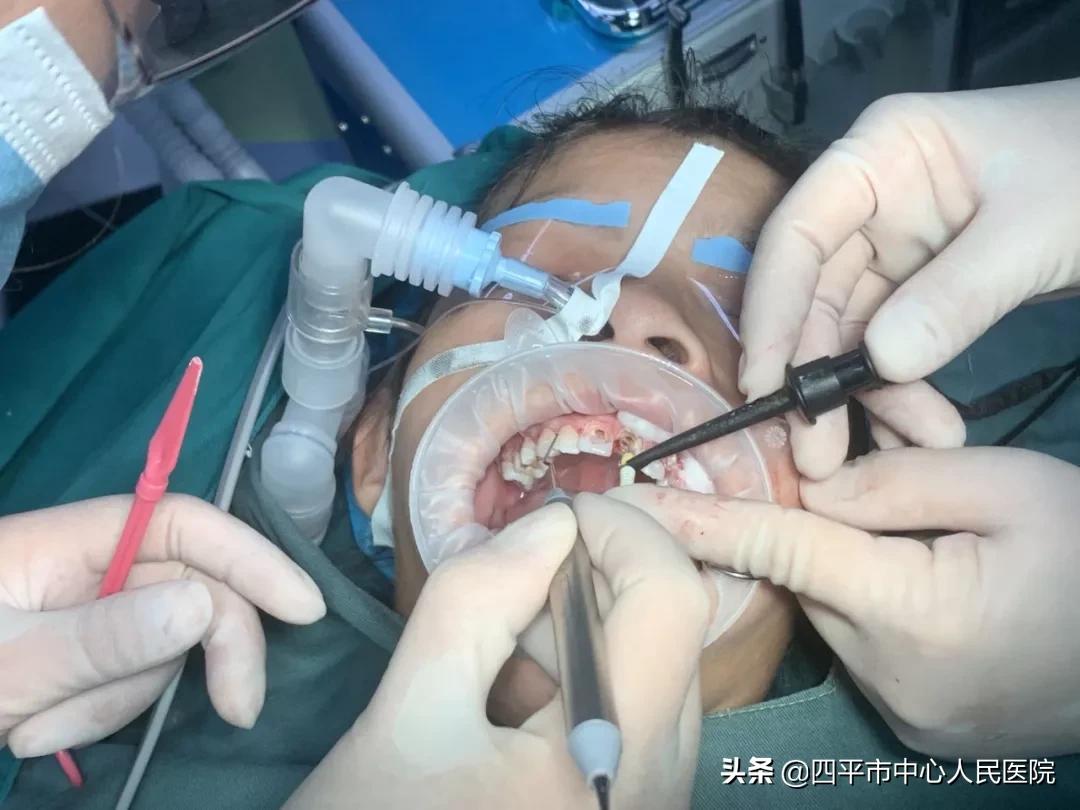 使用这个方法让孩子告别蛀牙,告别蛀牙洞