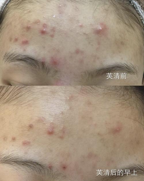 医美面膜修复祛红,10大美容中草药面膜