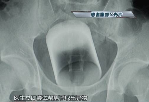 不忍直视！老哥直肠塞进直径7cm广口玻璃杯！这回菊花真的残了