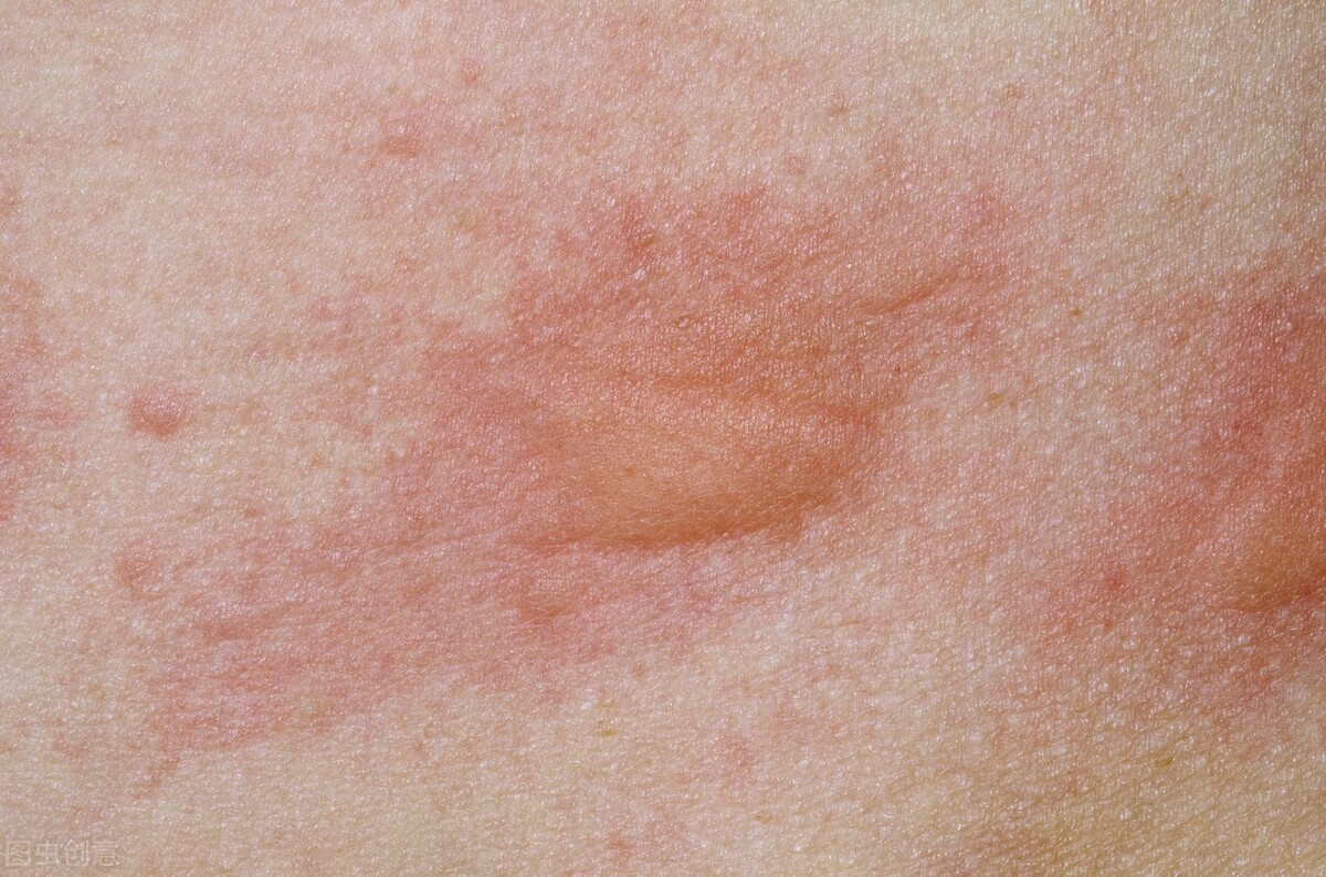 老是长风团荨麻疹是哪里出问题,总起丘疹性荨麻疹