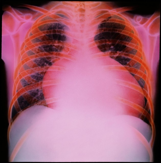 家里老人心脏病犯了怎么办,家人心血管疾病严重怎么办