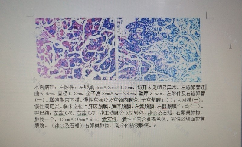 患者女46岁1年前发现盆腔肿物,盆腔肿物卵巢癌