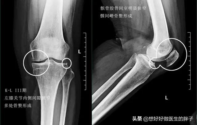 膝盖骨刺初期有什么症状,膝盖骨刺最严重后果怎样