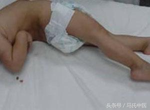 项背反张,项背强直中医怎么解释