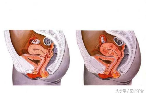 子宫内膜异位症严重有什么后果,子宫内膜异位症危害大吗