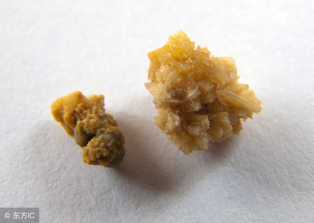 肾结石最佳治疗时间如何治疗