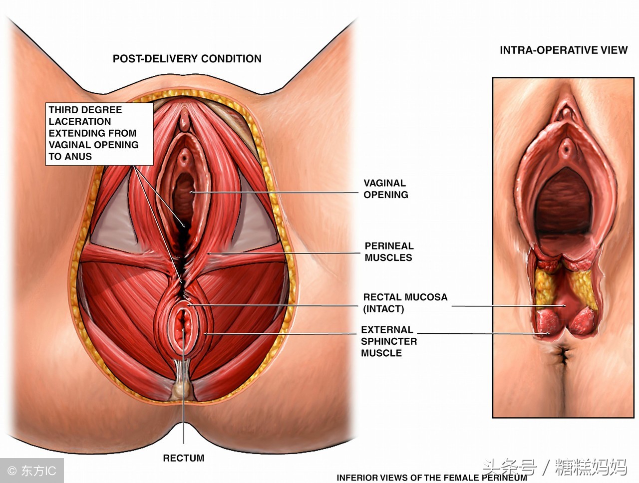 顺产为什么侧切缝了线后要拆,顺产侧切怎么才算好彻底了