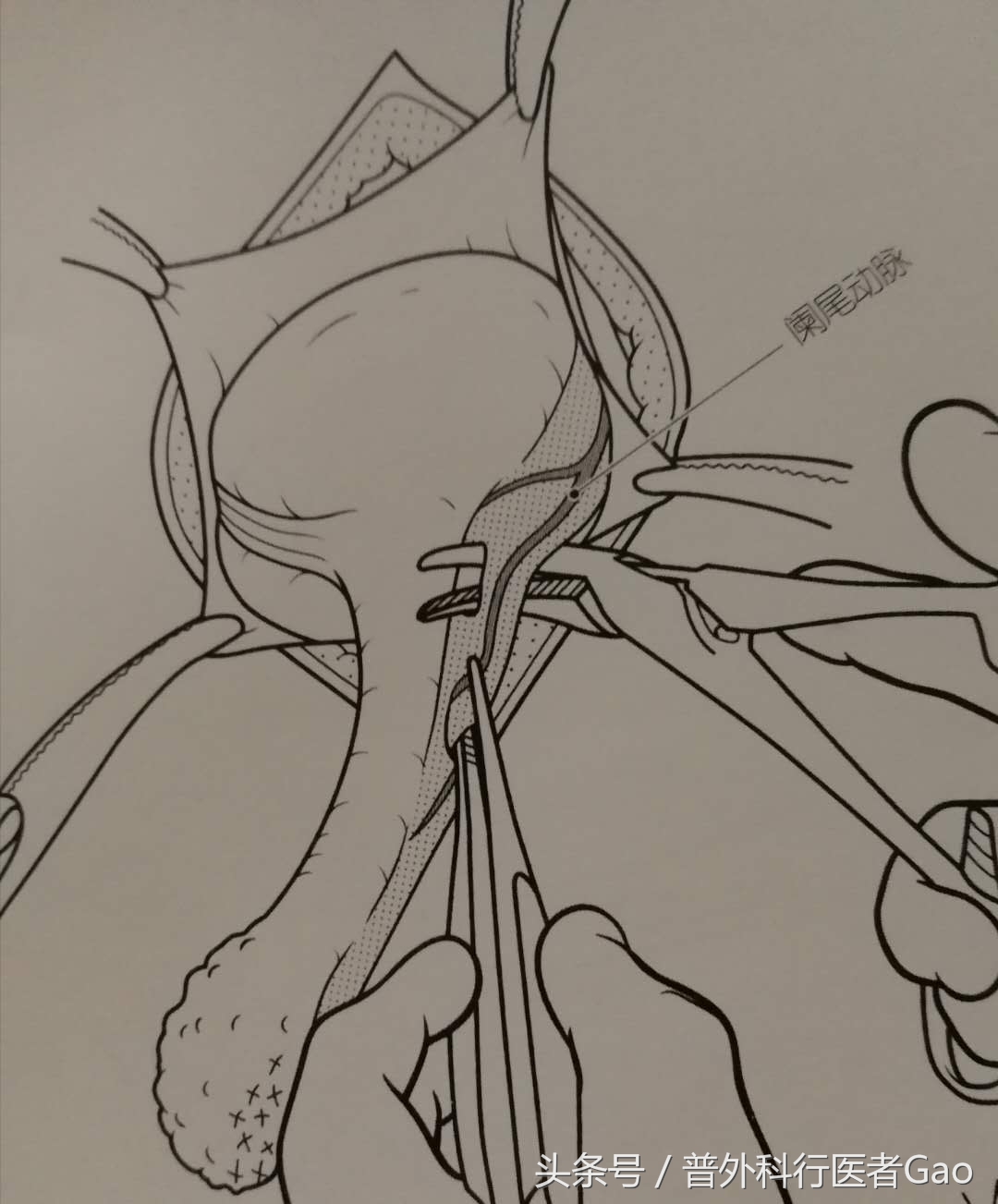 鏉忎粊鑳芥不闃戝熬鐐庡悧,鏉忎粊鍒囬櫎