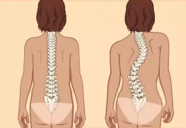 孩子脊柱弯了怎么矫正视频,孩子的脊柱怎么弯