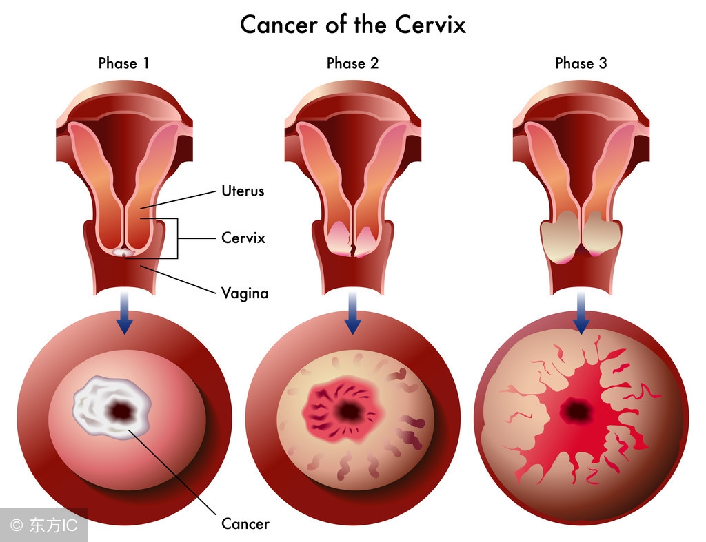 子宫囊肿是严重的病吗,子宫附件囊肿怎么判断良性恶性