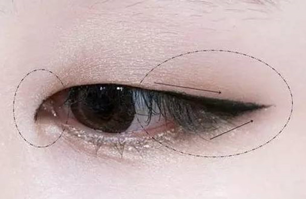 内双变外双又没了怎么办,内双变外双不复原