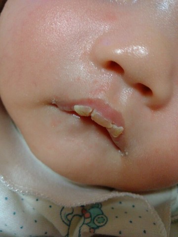 宝宝嘴唇干燥掉皮,宝宝嘴唇脱皮怎么处理