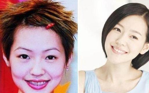 高圆圆戴牙套前后对比,高圆圆牙齿矫正牙套戴了几年