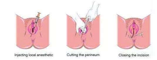 10个顺产9个侧切？关于侧切的这些小常识你必须懂！