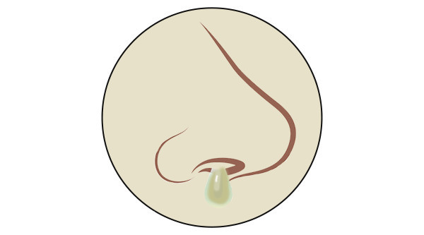 流不同颜色的鼻涕代表什么,鼻子有浓稠黄鼻涕是什么原因