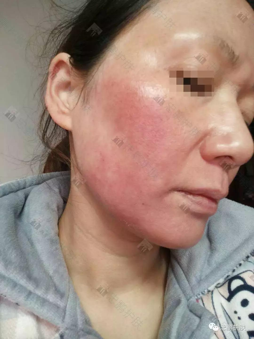 激素脸发红发热脱皮怎么办呢,激素脸为什么会扩散到脖子上代谢