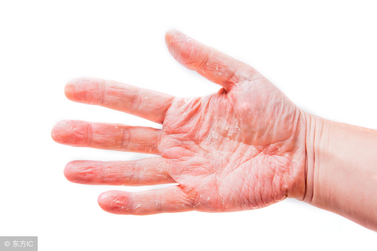 神经性皮炎在饮食上注意什么,得了神经性皮炎吃什么口服药