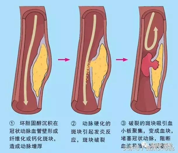 心肌梗塞的自救方法只有10秒,心肌梗塞自救10秒视频