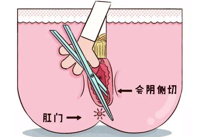 会阴切开术的指征,会阴切开禁忌症
