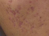 皮肤科医生是怎么祛痘祛痘坑的,皮肤科专家美容祛斑方法