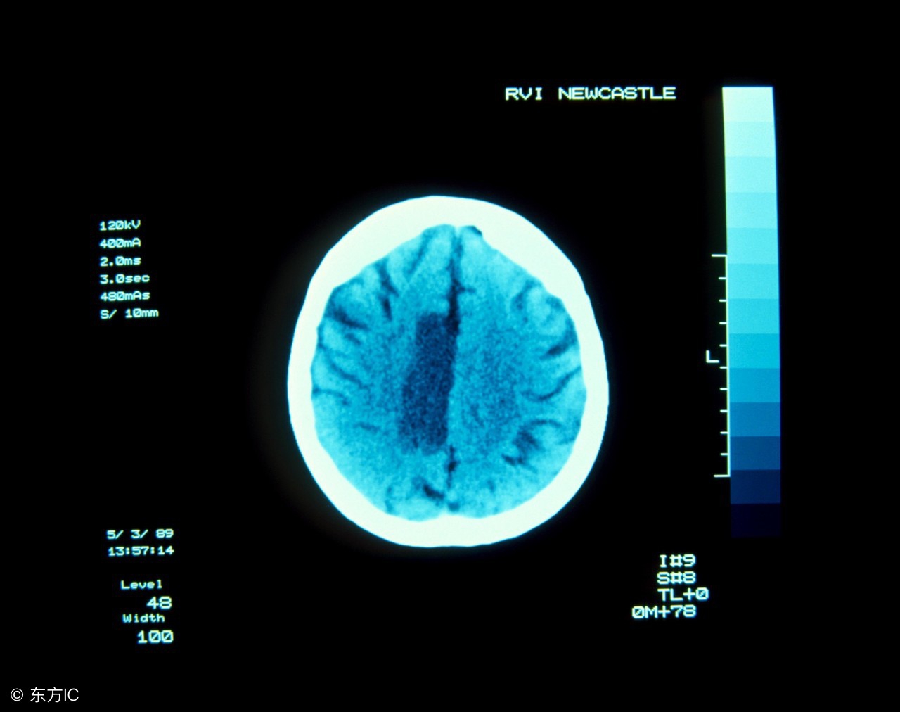 脑梗塞饮食上注意什么,脑梗塞患者的饮食需要注意什么