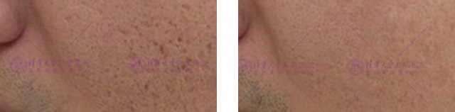 想要快速祛痘印你必须知道这的知识点