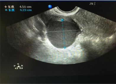 卵巢囊肿都需要做肿瘤标志物吗,卵巢囊肿都需要治疗吗