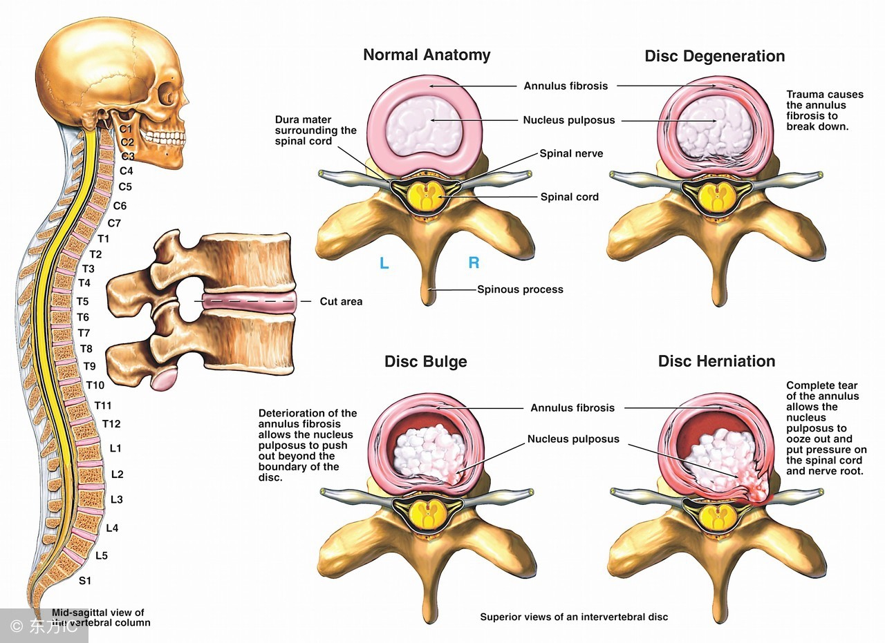 腰椎间盘突出腿痛按摩哪些穴位,腰椎间盘突出压迫神经屁股疼腿痛