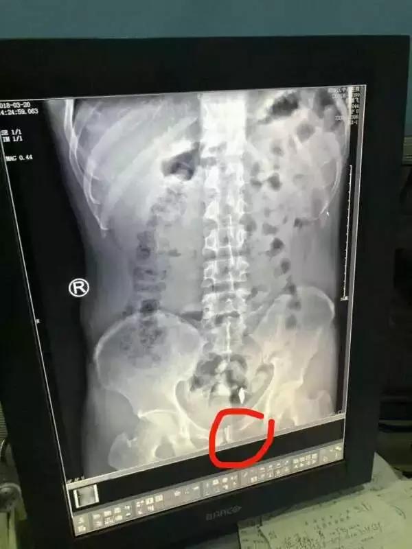 吸毒吞刀片为什么不会被抓,吸毒吞刀片啥意思