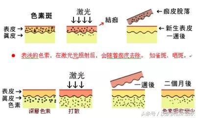 皮肤美容春夏秋冬护理方案,宋丽秋激光祛斑