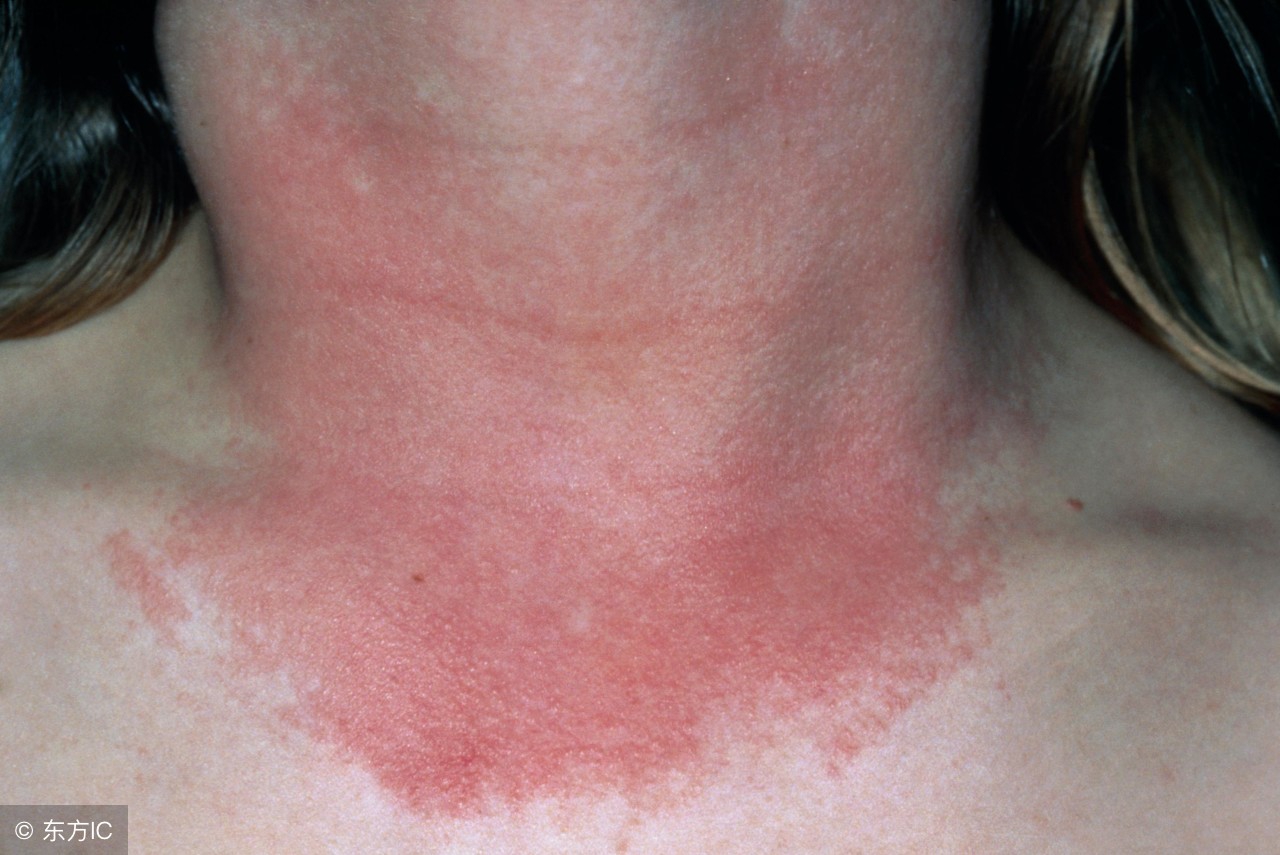 脂溢性皮炎毛囊炎外用药哪个好用,脂溢性皮炎头皮屑多用什么外用药