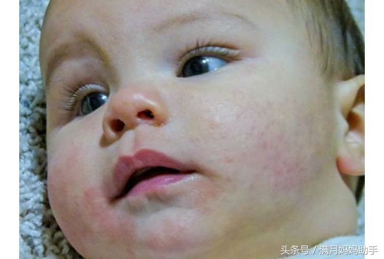 宝宝胳肢窝起红疹子什么原因,宝宝胳肢窝红图片