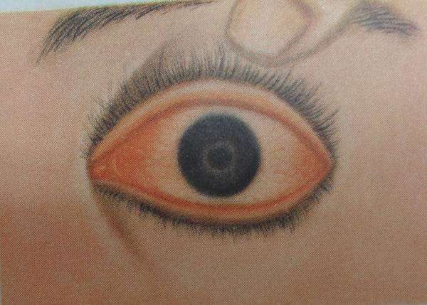 角膜炎结膜炎致眼流泪,角膜炎结膜炎眼部充血用什么药