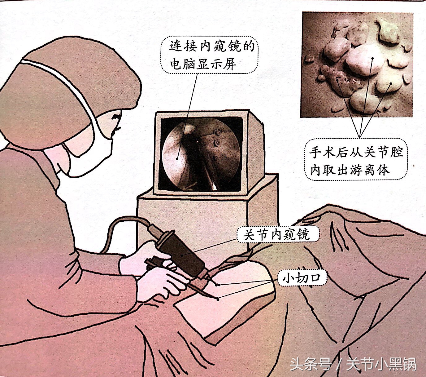 关节镜微创手术适应症有哪些,微创手术和关节镜有什么区别