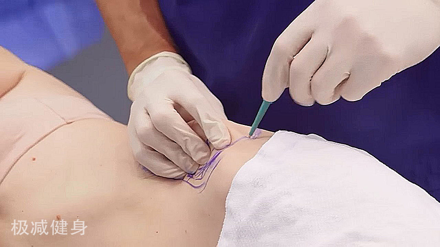 抽脂减肥的五大误区,减肥抽脂的过程是怎样的