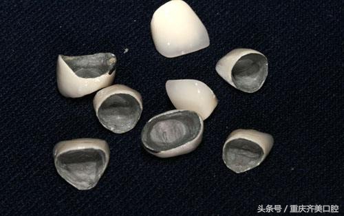 你的烤瓷牙会不会崩瓷,你的烤瓷牙冠有黑边缘吗