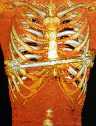 漏斗胸矫正微创手术,最新的漏斗胸微创手术