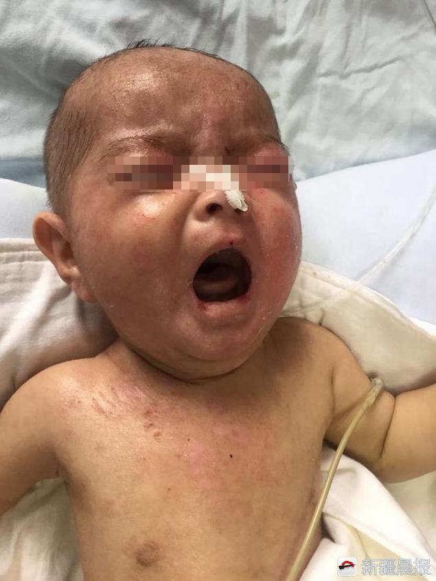 宝宝长水痘什么情况下住院治疗,40天的宝宝刚得水痘吃药控制住吗