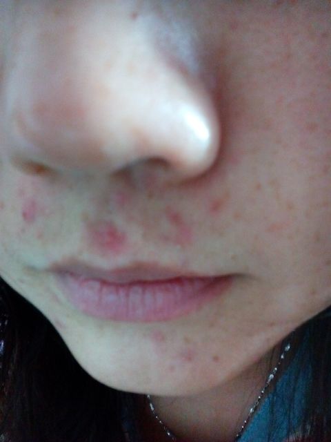 祛痘面膜真的可以祛痘吗,芙清祛痘面膜效果怎么样